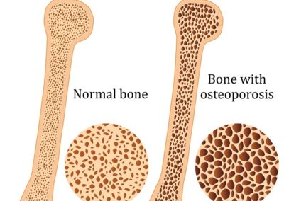 Exercise and Osteoporosis