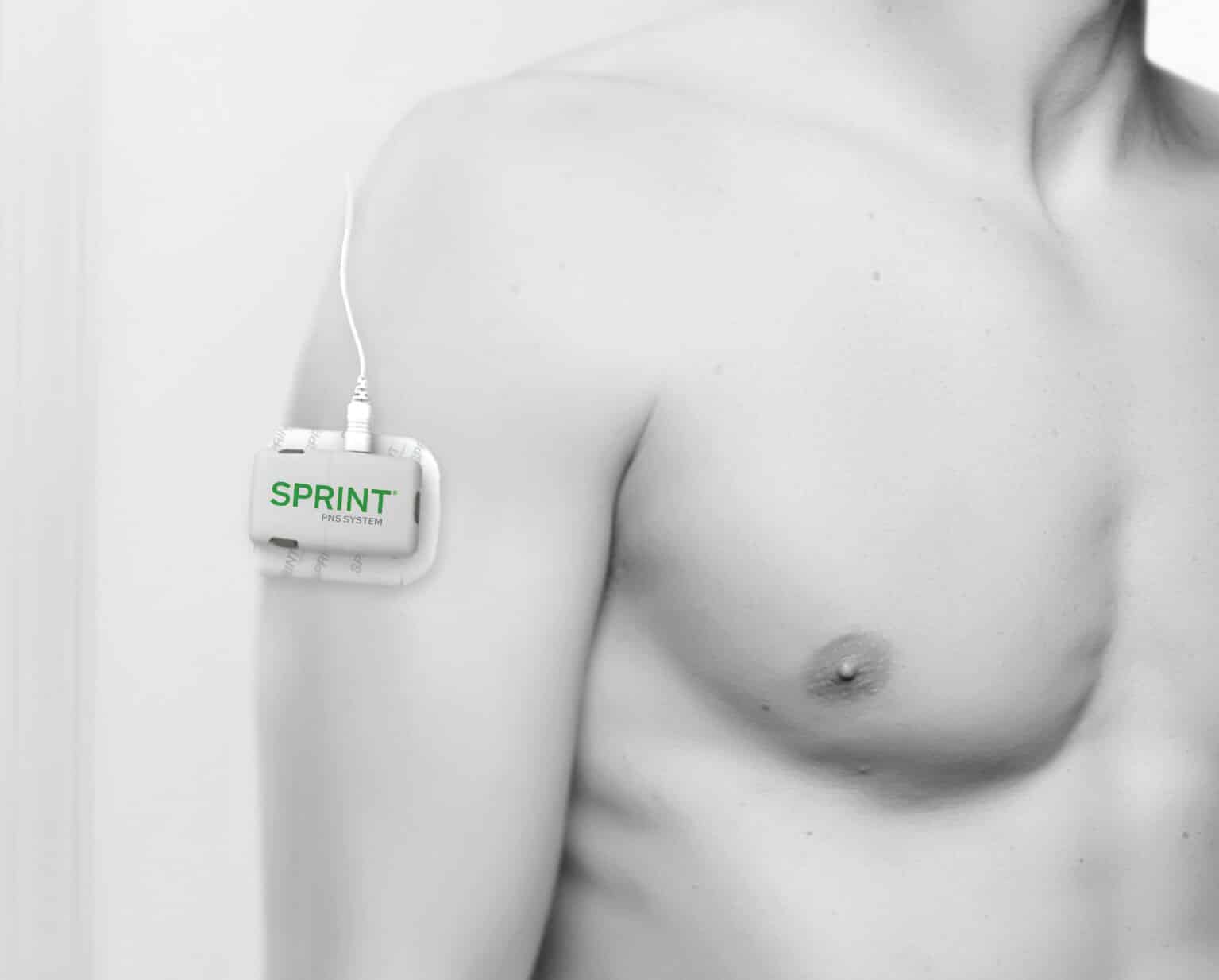 SPRINT PNS device on arm