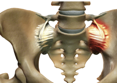 Illustration of pelvis SI joint pain