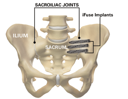 Sacroiliac Joint illustration